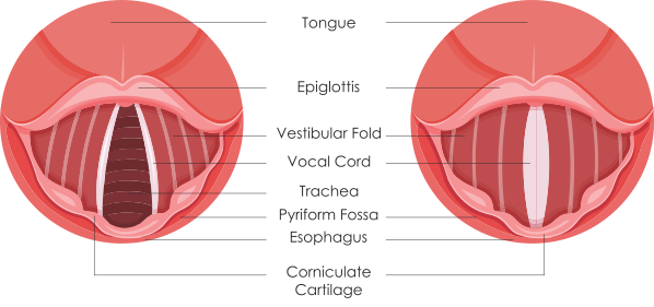 Vocal Nodules and Vocal Health