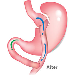 The Gastric Bypass Surgery—Does it work?